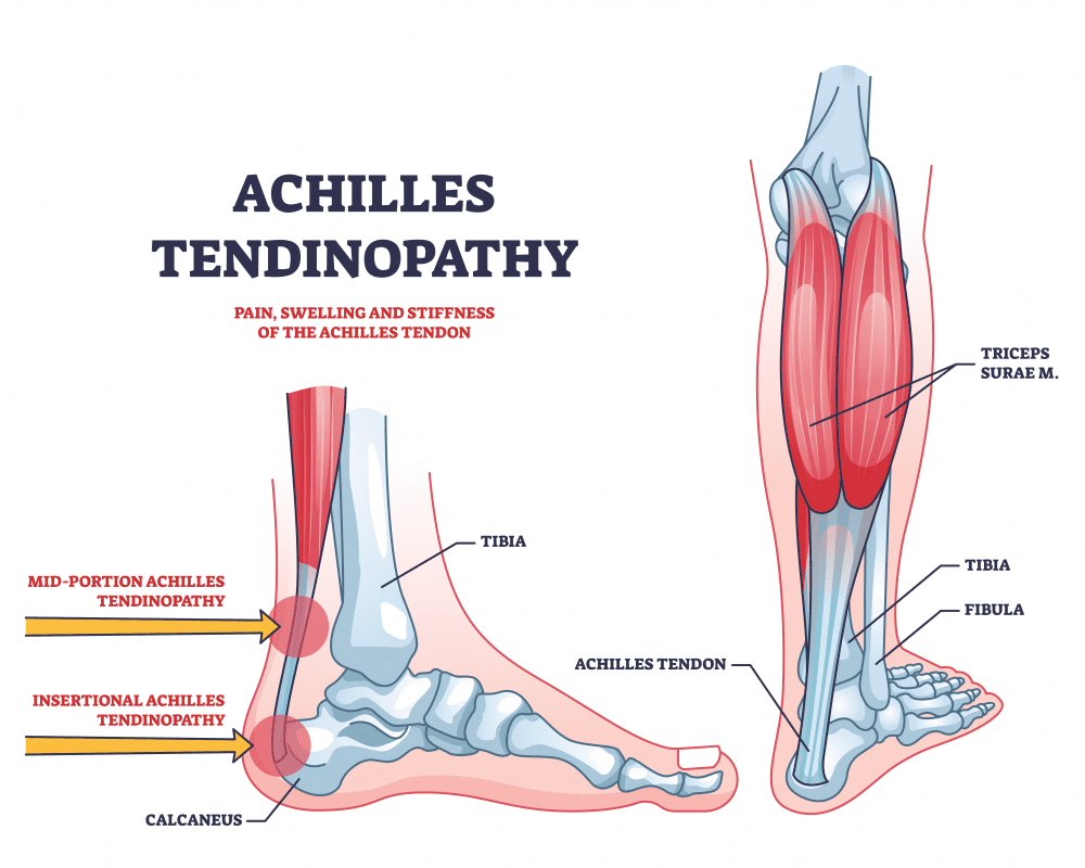 achilles-tendinitis-symptoms-causes-prevention