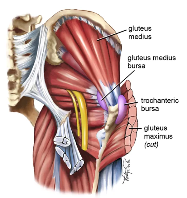 Understanding Gluteal Tendinopathy: Causes, Symptoms, and Effective Treatments