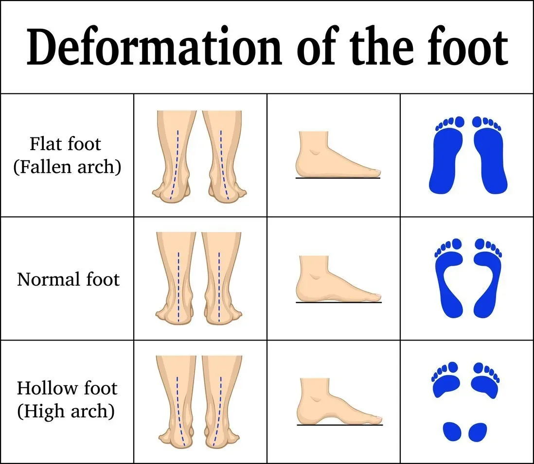 Flat feet – Symptoms and causes