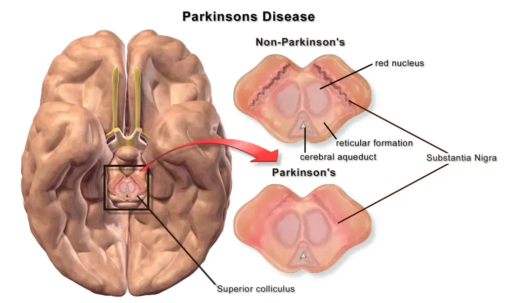 Parkinson's Disease - Symptoms, causes and Rehabilitation