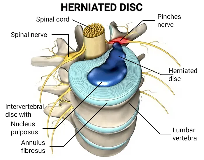 Herniated Disc Symptoms: Causes, Treatment