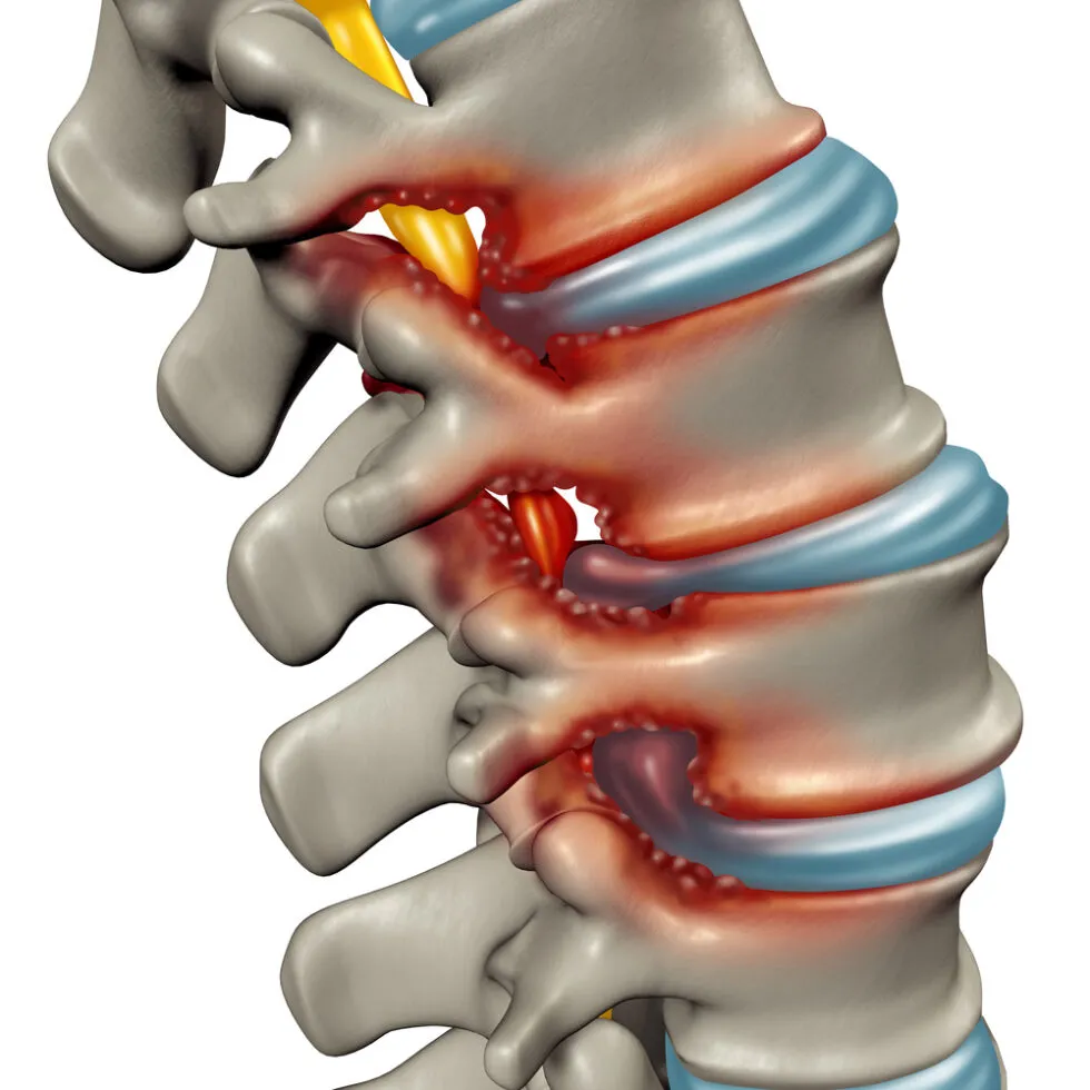 Spinal Stenosis: Unraveling the Causes and Symptoms
