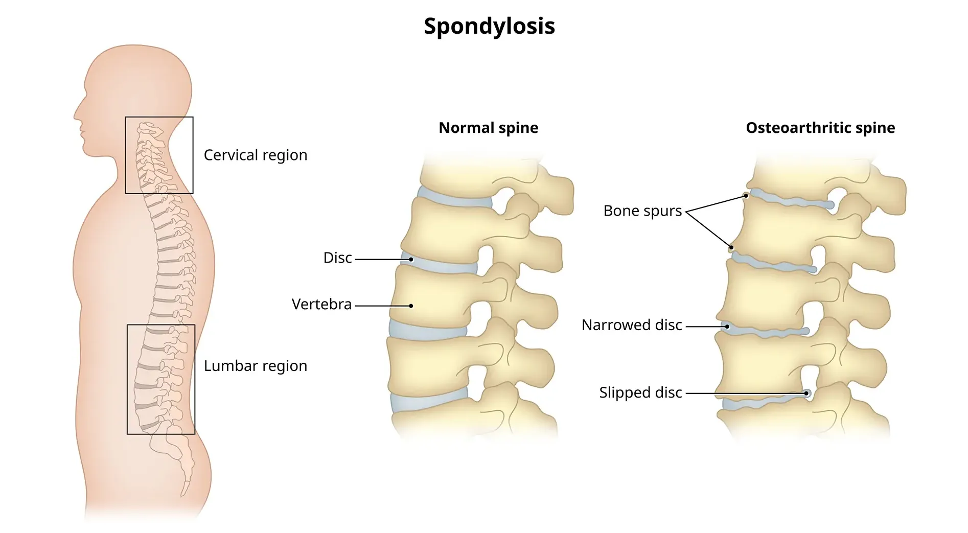 Cervical spondylosis and neck pain