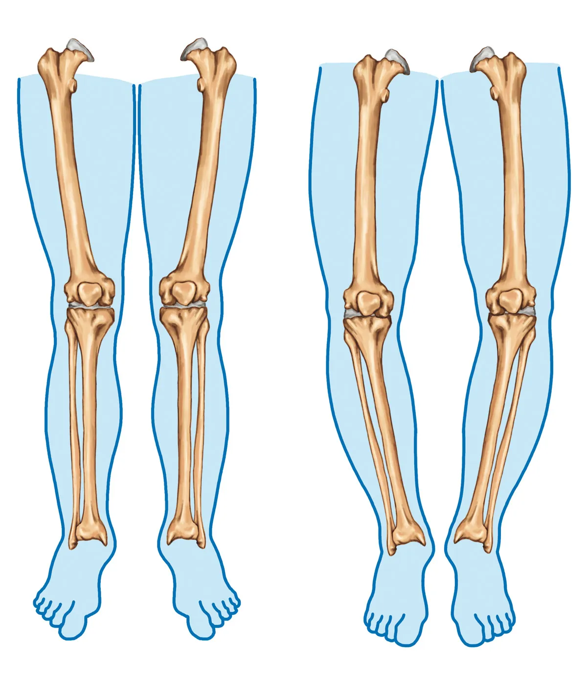 Bow Legged : What Is It, Causes & Treatment