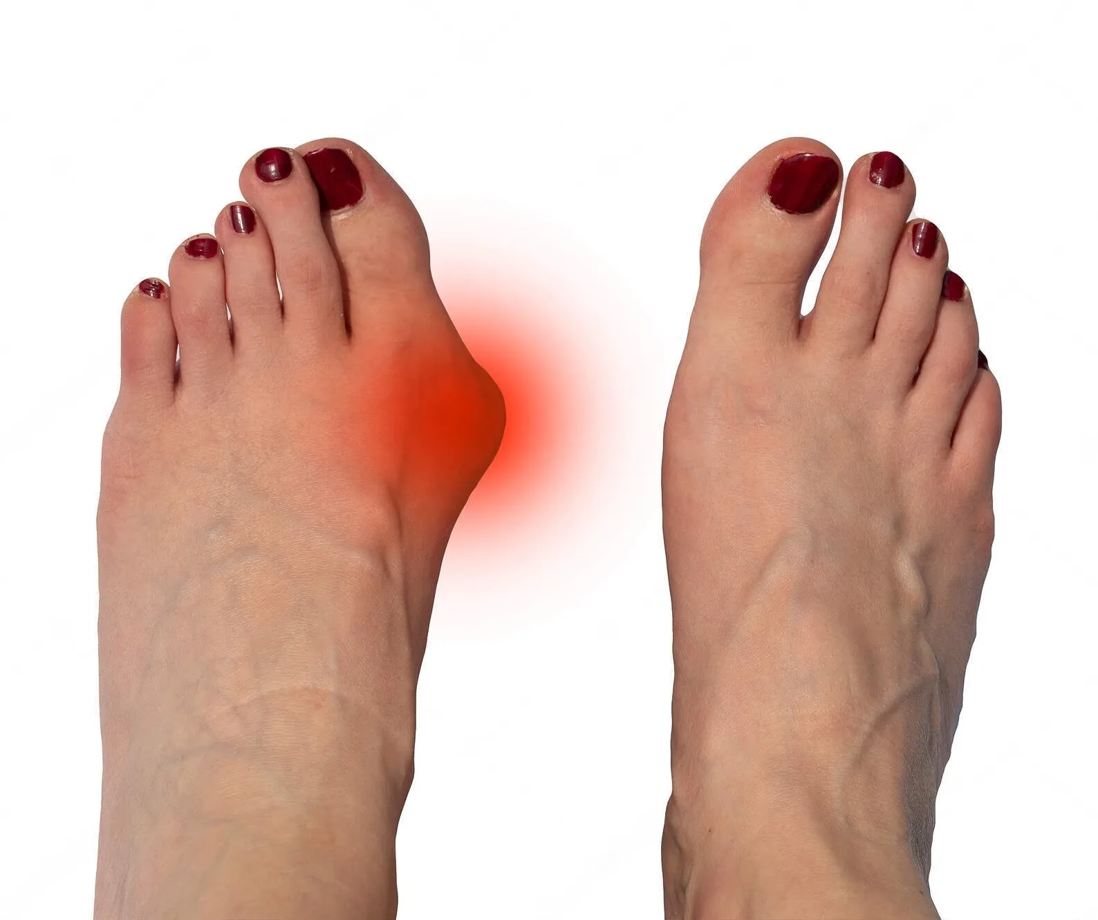 HOW CAN I SHRINK MY BUNIONS NATURALLY?