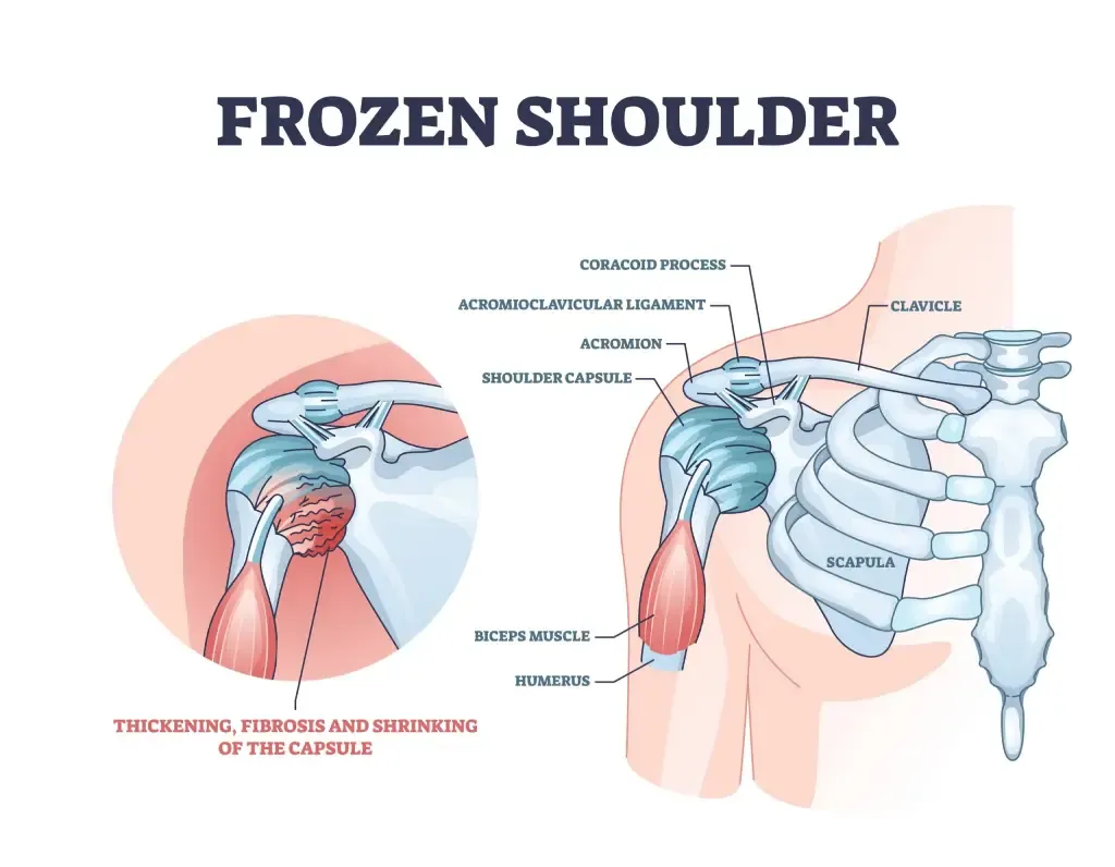 Frozen shoulder - Diagnosis and treatment