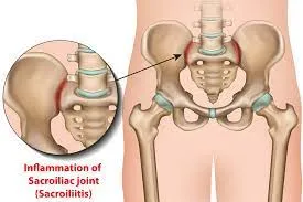 Sacroiliac Joint Dysfunction: Unraveling the Causes, Symptoms, and Effective Management
