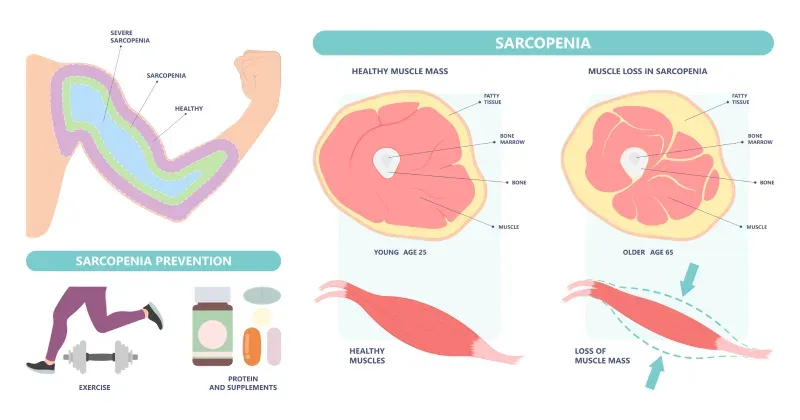 Sarcopenia (Muscle Loss): Symptoms & Causes