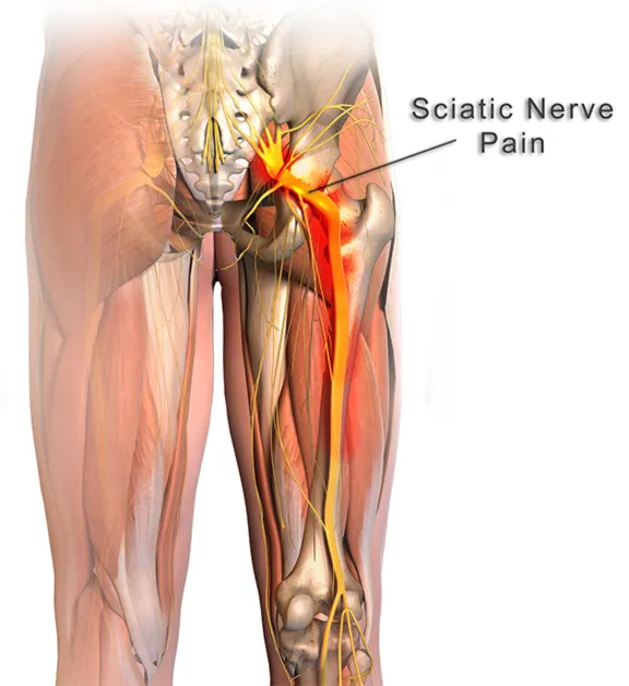 Understanding Sciatica: Causes, Symptoms, and Treatment Options.