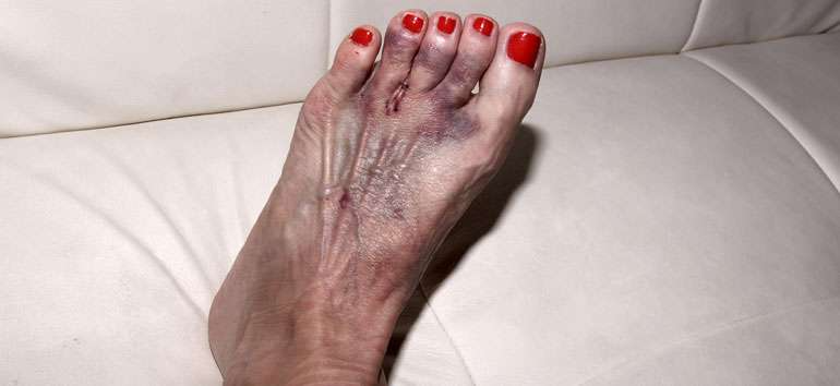 Foot Pain Causes Morton Neuroma