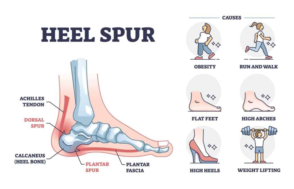 Heel spur  causes & treatment