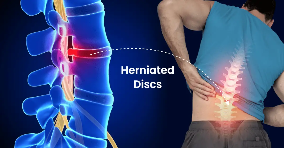 Herniated Disc: Understanding Causes, Symptoms, and Treatments