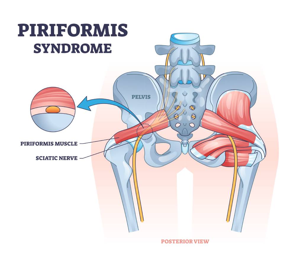 Piriformis syndrome, symptoms, prevention and treatment options